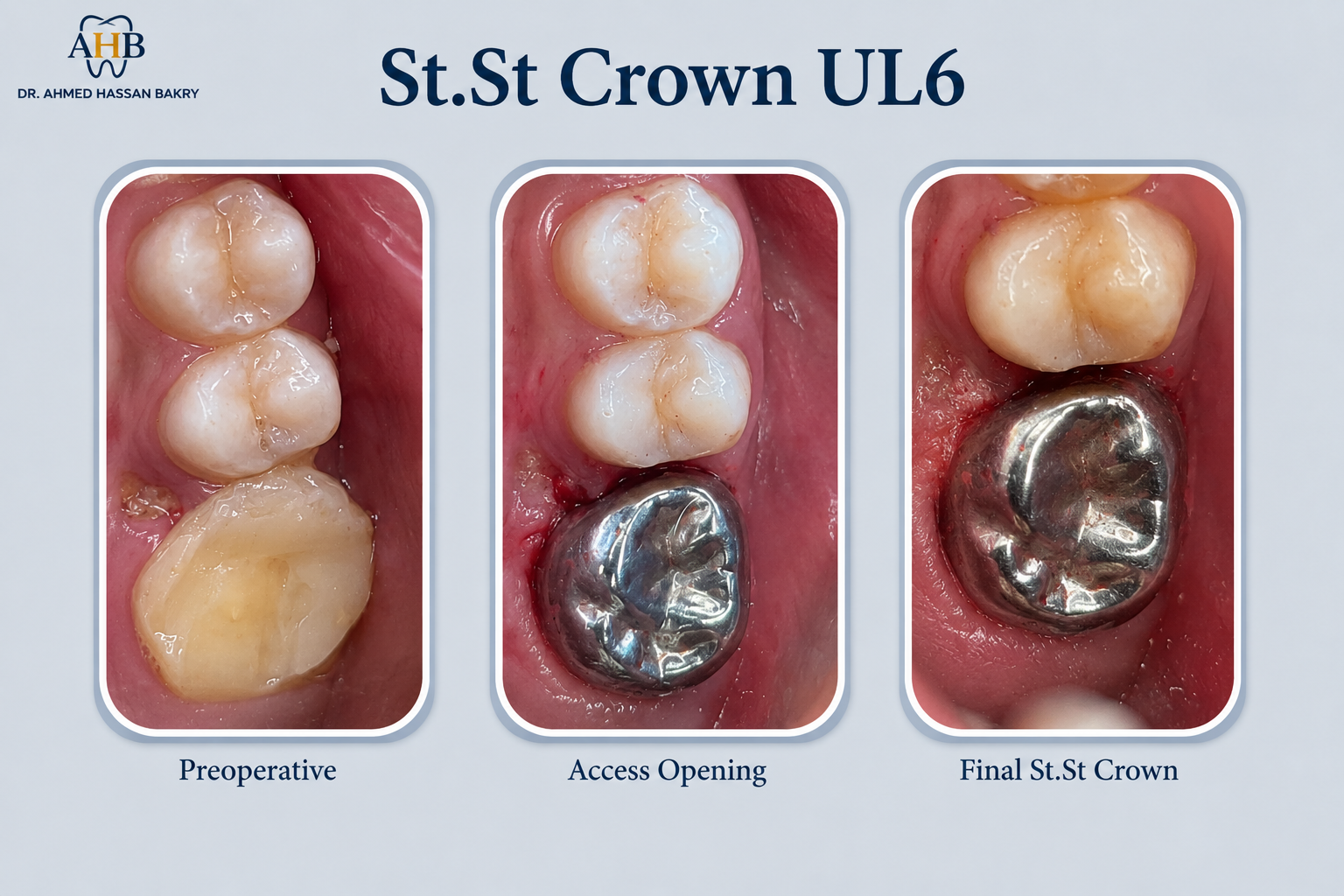 St.St Crown UL6